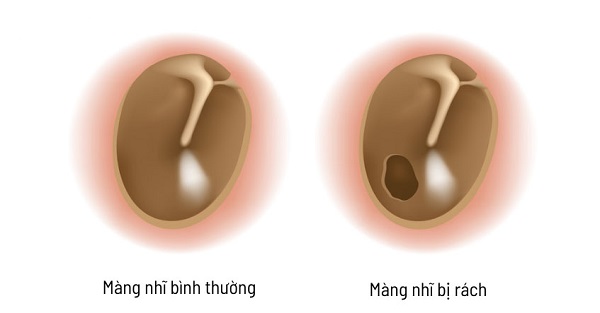 [CẢNH BÁO] Đề phòng những tổn thương màng nhĩ ngày càng gia tăng!