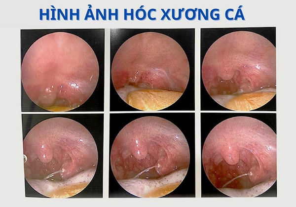 Bị hóc xương cá phải làm sao? – Gợi ý cách xử lý đúng đắn khi bị hóc xương cá