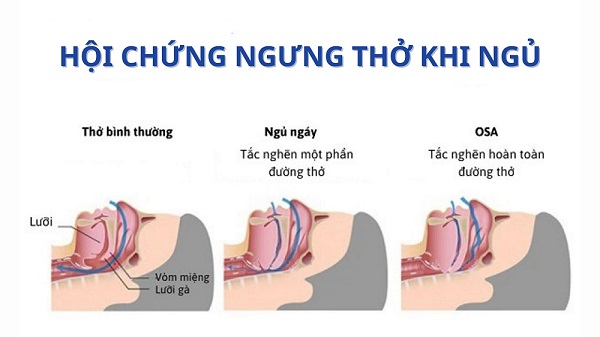 Ngưng thở khi ngủ: Nguyên nhân, Triệu chứng và Cách điều trị