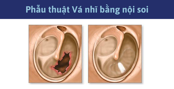Vá màng nhĩ nội soi: Giải pháp hiệu quả cho tổn thương màng nhĩ