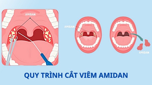 [Giải đáp] Cắt amidan có nguy hiểm không?