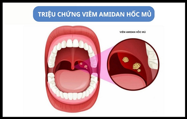 Muốn hiểu hết về viêm amidan có mủ – đọc ngay bài viết này