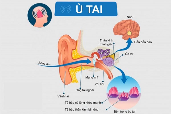 Ù tai – Chớ coi thường dấu hiệu “cảnh báo bệnh lý” nguy hiểm!