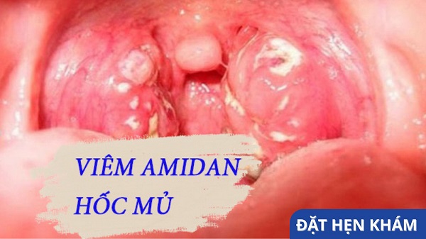 Muốn chữa khỏi viêm amidan hốc mủ hãy đọc hết bài viết sau đây!