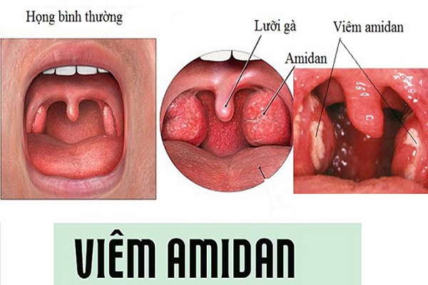 [GIẢI ĐÁP] Cắt viêm amidan – Khi nào nên thực hiện?