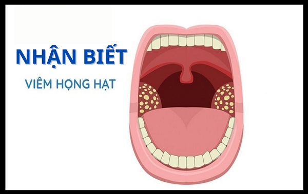 [TỔNG QUAN] Viêm họng hạt và những thông tin quan trọng cần biết