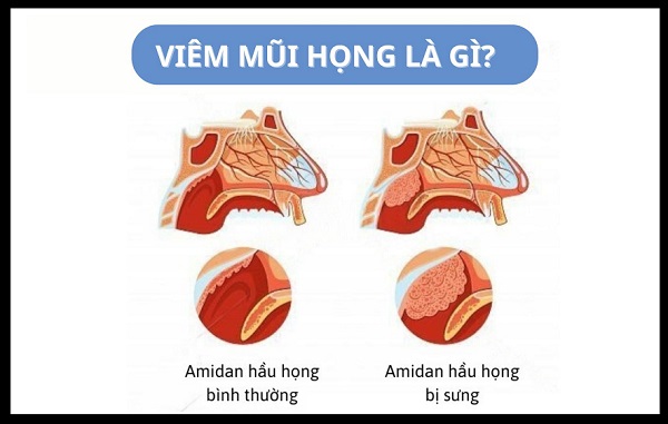 [CHIA SẺ] Tất tần tật thông tin quan trọng về bệnh lý viêm mũi họng
