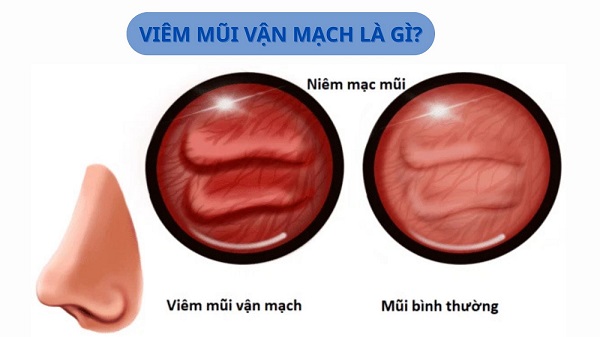 Tất tần tật thông tin quan trọng về bệnh lý viêm mũi vận mạch mà bạn cần biết