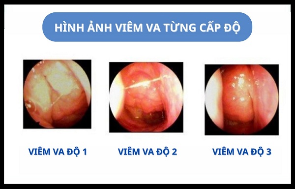 Hình ảnh viêm VA: Yếu tố hàng đầu giúp chẩn đoán chính xác bệnh lý!