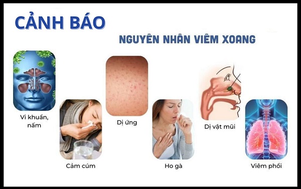 Nhận biết sớm dấu hiệu viêm xoang để chủ động thăm khám, điều trị