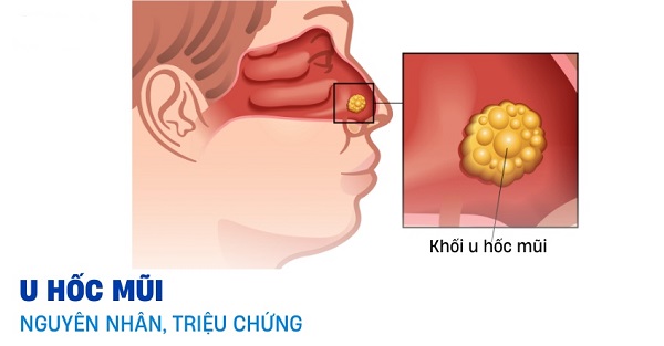 Đừng chủ quan khi bị u hốc mũi – Bạn đã hiểu hết về căn bệnh nguy hiểm này chưa?