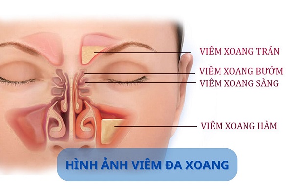 Bất ngờ với bệnh viêm đa xoang gây nhiều biến chứng nguy hiểm