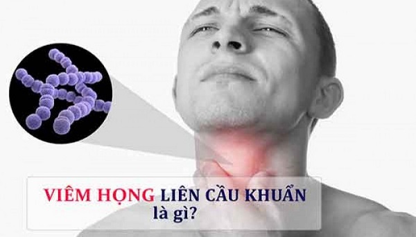 [Tổng quan] Bệnh viêm họng liên cầu khuẩn và những điều cần biết
