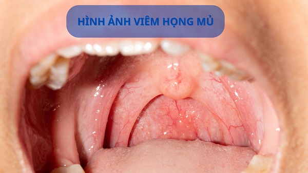 Viêm họng mủ: Sớm nhận biết nguyên nhân, dấu hiệu để kịp thời điều trị