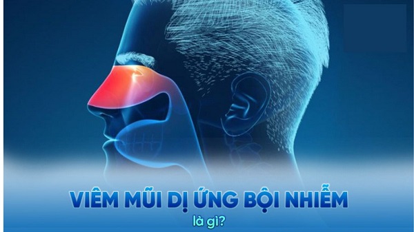 Chấm Dứt Viêm Mũi Dị Ứng Bội Nhiễm: Giải Pháp Hiệu Quả