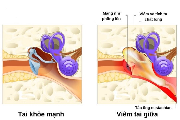 Vì sao bạn thường xuyên bị viêm tai giữa? 7 thủ phạm ít ai ngờ tới
