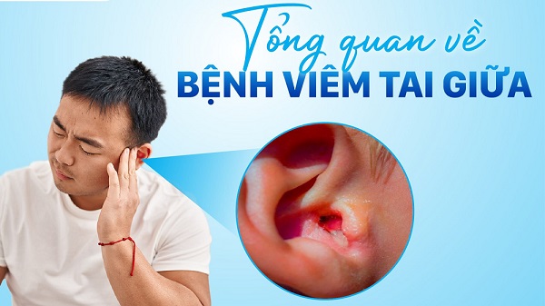 Hướng dẫn điều trị viêm tai giữa: Khoa học, an toàn và dễ áp dụng