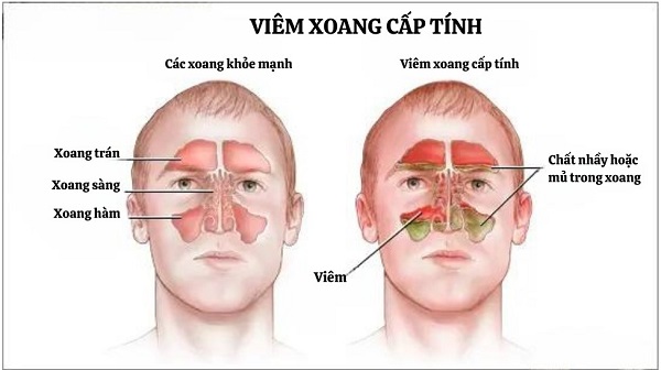 Cẩn thận bệnh lý viêm mũi xoang – Không thể tự khỏi, dễ gây biến chứng!