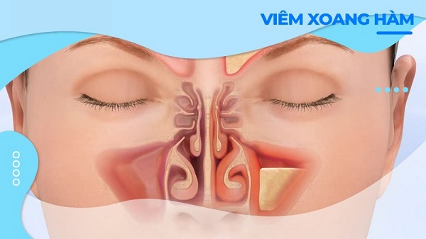 Dấu hiệu nhận biết viêm xoang hàm mãn tính và điều trị hiệu quả, tránh tái phát