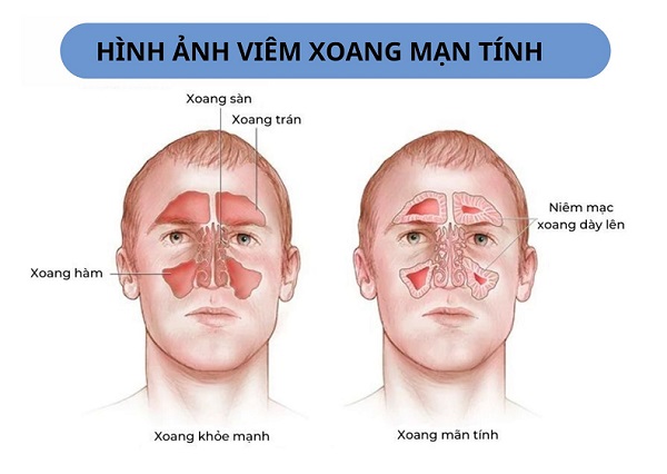 Dấu hiệu viêm xoang mãn tính: Nhận biết sớm – Điều trị nhanh!