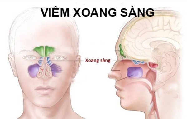 Viêm xoang sàng là gì và cách điều trị bệnh viêm xoang sàng?