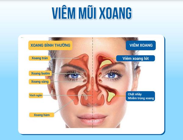 Ngạt mũi, đau đầu triền miên? Coi chừng viêm đa xoang
