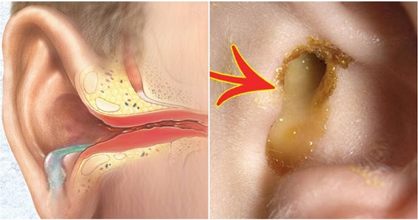 Đau tai, nhức tai, có chảy dịch tai: 3 Dấu hiệu cảnh báo nhiễm trùng nặng cần khám gấp