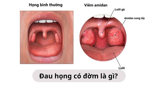 Giải mã triệu chứng đau họng có đờm – Bác sĩ chỉ ra điều nhiều người vẫn hiểu sai
